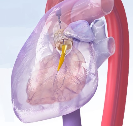 Christus Spohn’s TAVR Program Gives New Life to Cardiac Patients