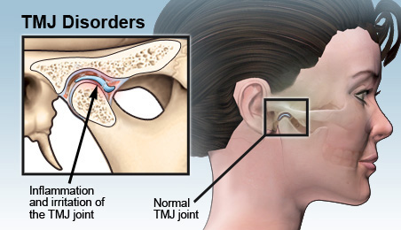 TMJ DISORDERS